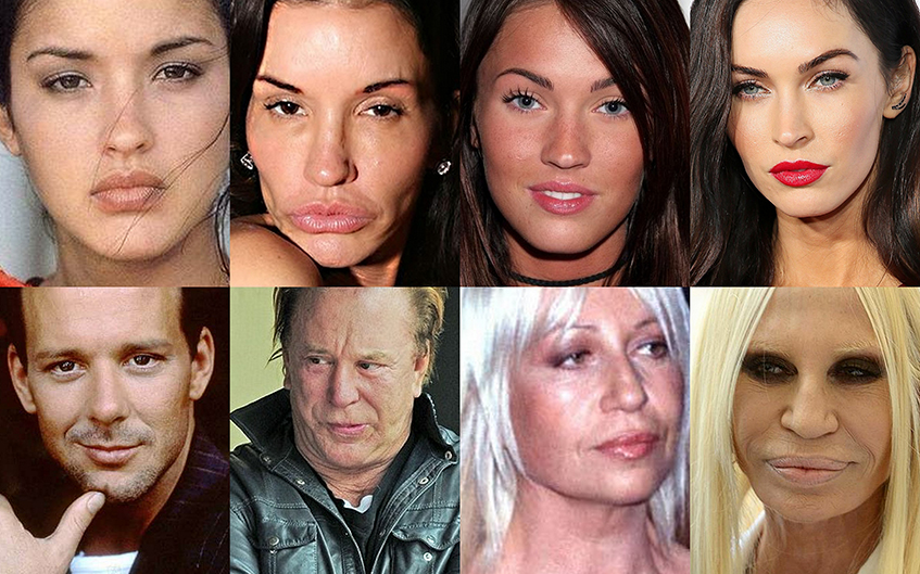 Звезды, чью жизнь изменила пластическая хирургия