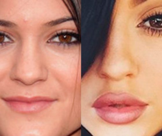 Звезды, которые увеличили губы