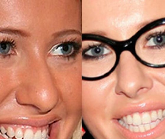 Звезды, которые сделали ринопластику