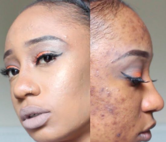 Как девушка скрывает акне косметикой