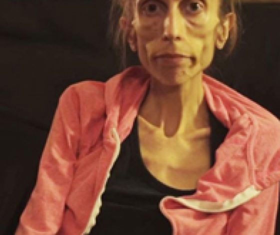 Люди собрали $180 тыс. для актрисы, больной анорексией