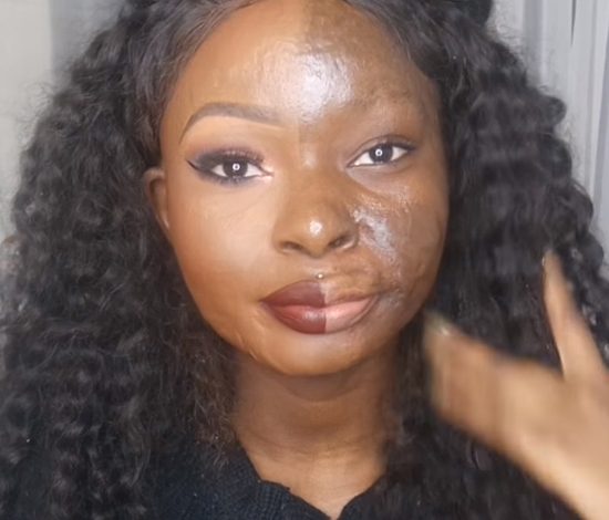 Девушка с сильным ожогом лица показала настоящую силу макияжа