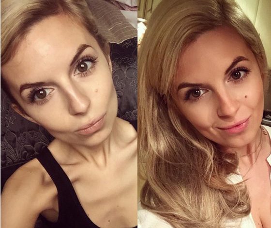 Instagram помог девушке победить анорексию