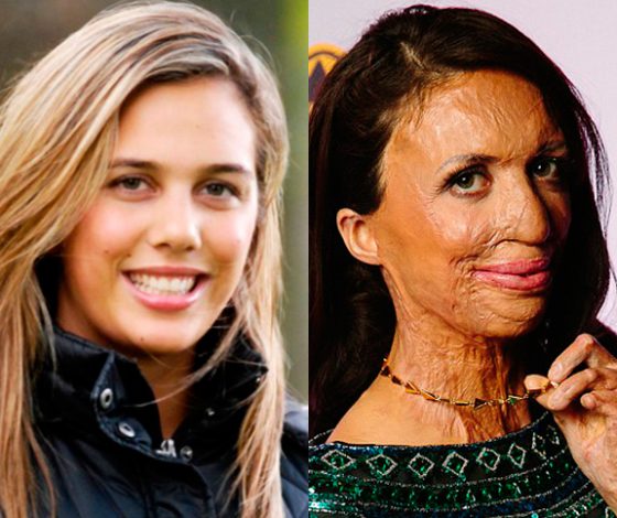 Как изменилась жизнь модели после страшного пожара