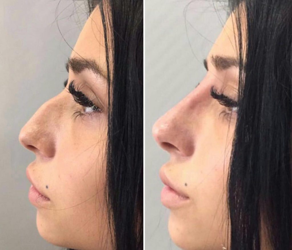 Как изменить форму носа без операции?