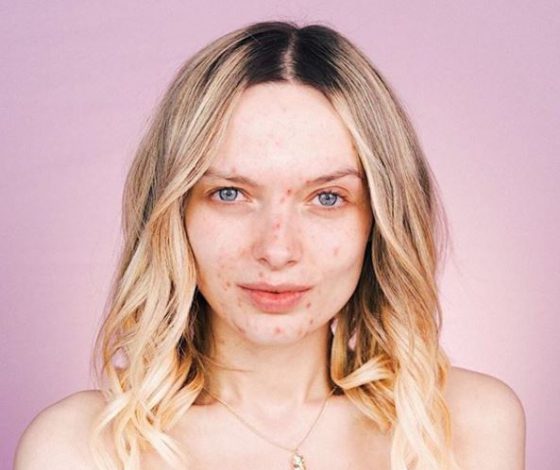 Бьюти-флешмоб: акнепозитив