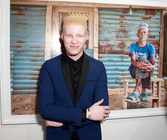 5 моделей с изъянами во внешности, которые они превратили в достоинство