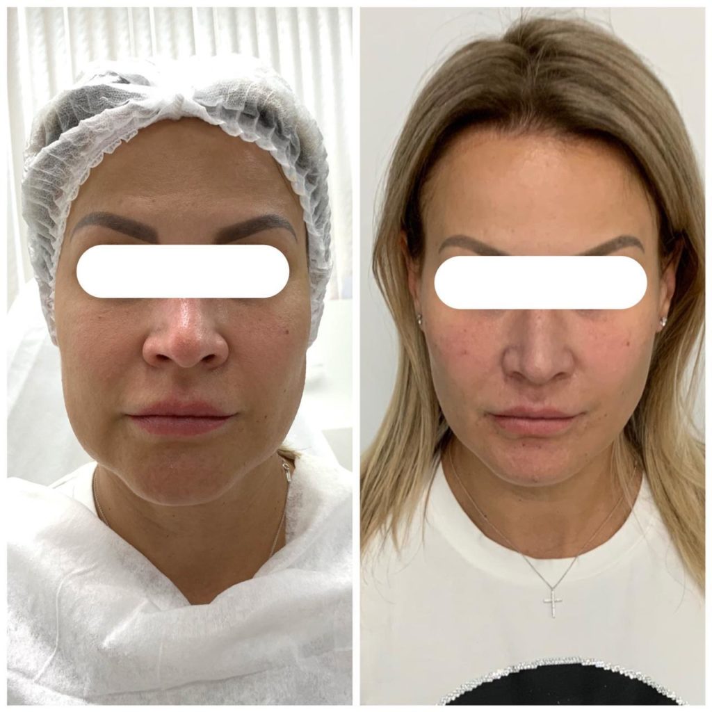 Результат до и после процедуры. Фото: клиники Ольги Мороз