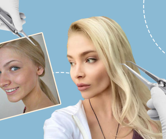 Cлишком рано начали: хирурги о пластике молодых знаменитостей