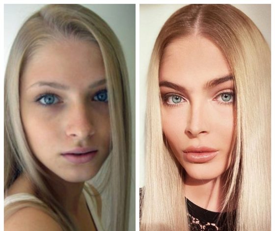 Вот это апгрейд: российские звезды до пластики