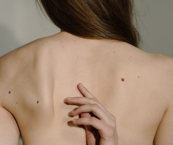 День диагностики меланомы: где в мае бесплатно проверить родинки на онкологию?