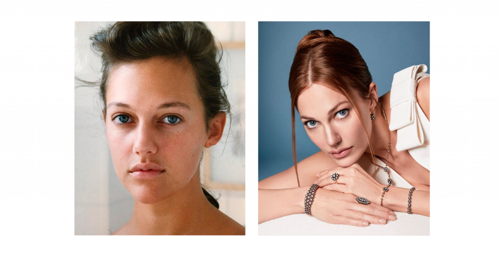 Узерли после пластики