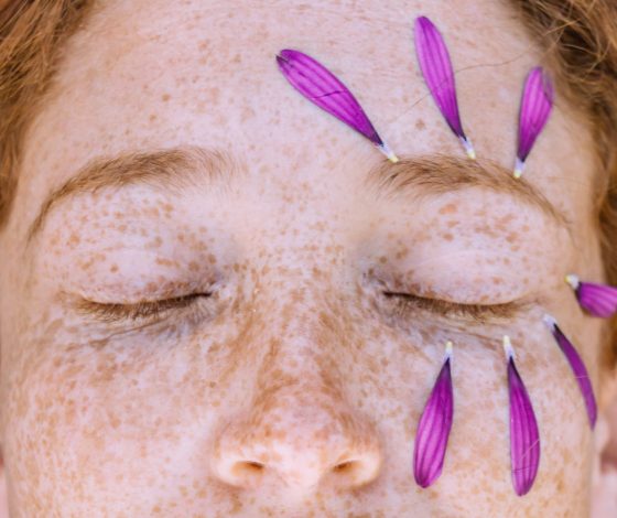 Замести следы: как избавиться от постакне? Лучшая косметика и косметологические процедуры