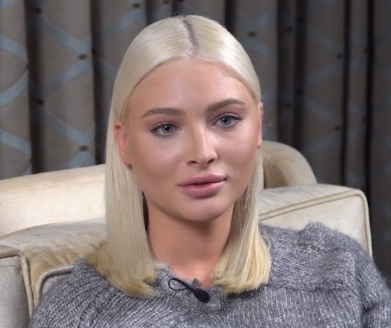 Что случилось с лицом Алены Шишковой? Рассказывает косметолог