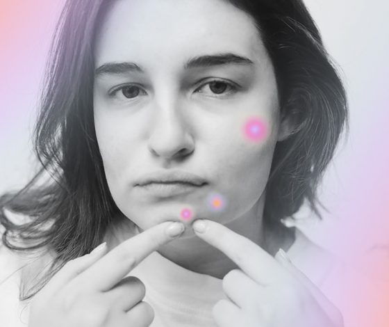 Почему у меня в 30 лет есть прыщи и как их вылечить?