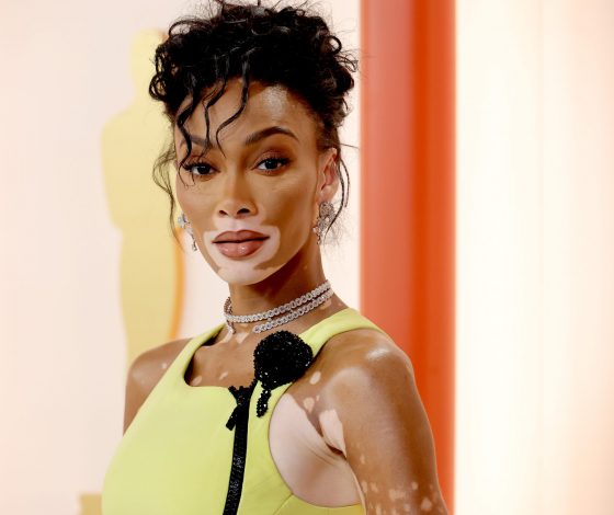 Самая известная модель с витилиго объявила о помолвке