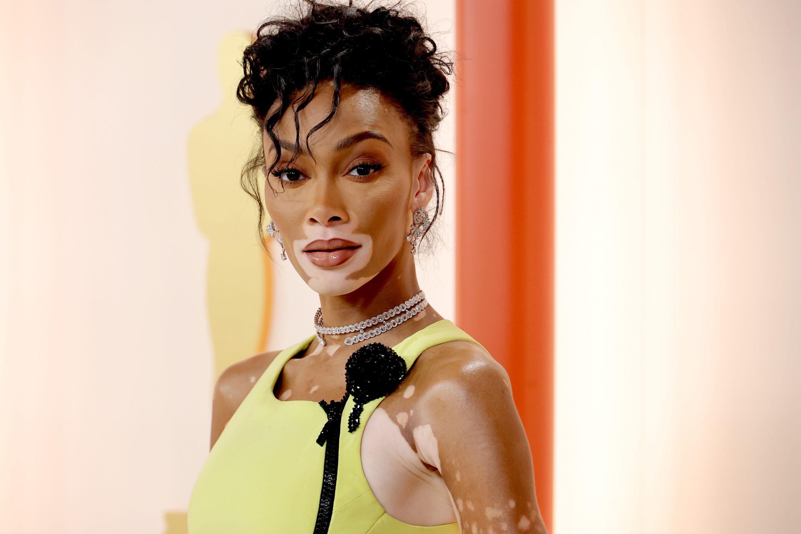 The most famous model with Vitiligo announced that he had an aim
