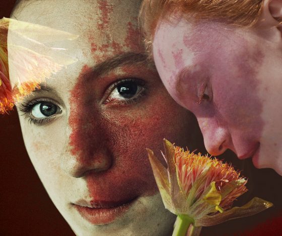 «Дети тыкали пальцем и обсуждали меня»: Тоня Рыбкина, модель с синдромом Штурге-Вебера, о комплексах и отношении к макияжу