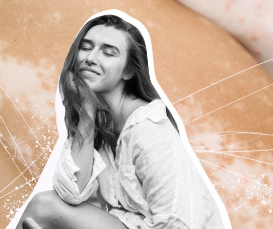 Белые соски и седые волосы, или История о том, как в 20 лет у меня появилось витилиго