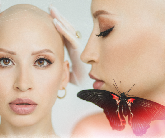 «За два месяца я осталась без 70 % волос на голове»: личная история о жизни с алопецией