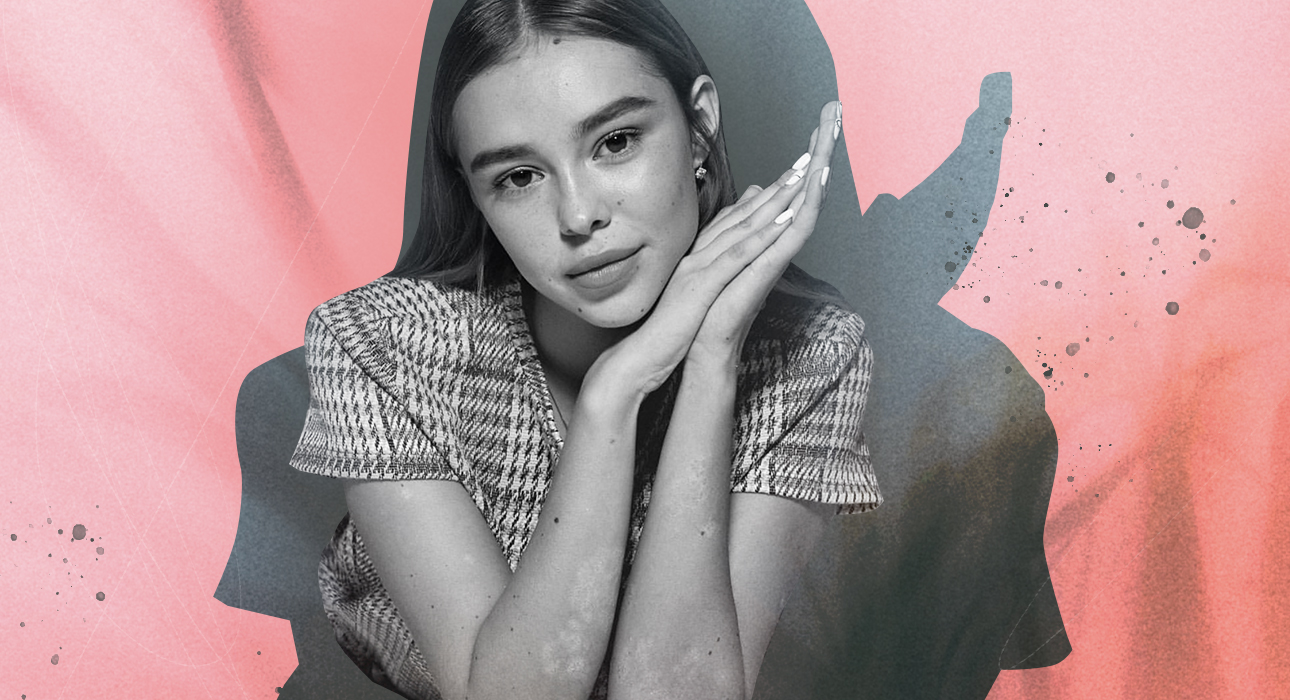 “I told everyone it was allergies”: a personal story about living with psoriasis