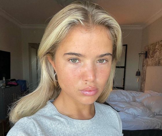 5 лучших косметологических процедур от постакне