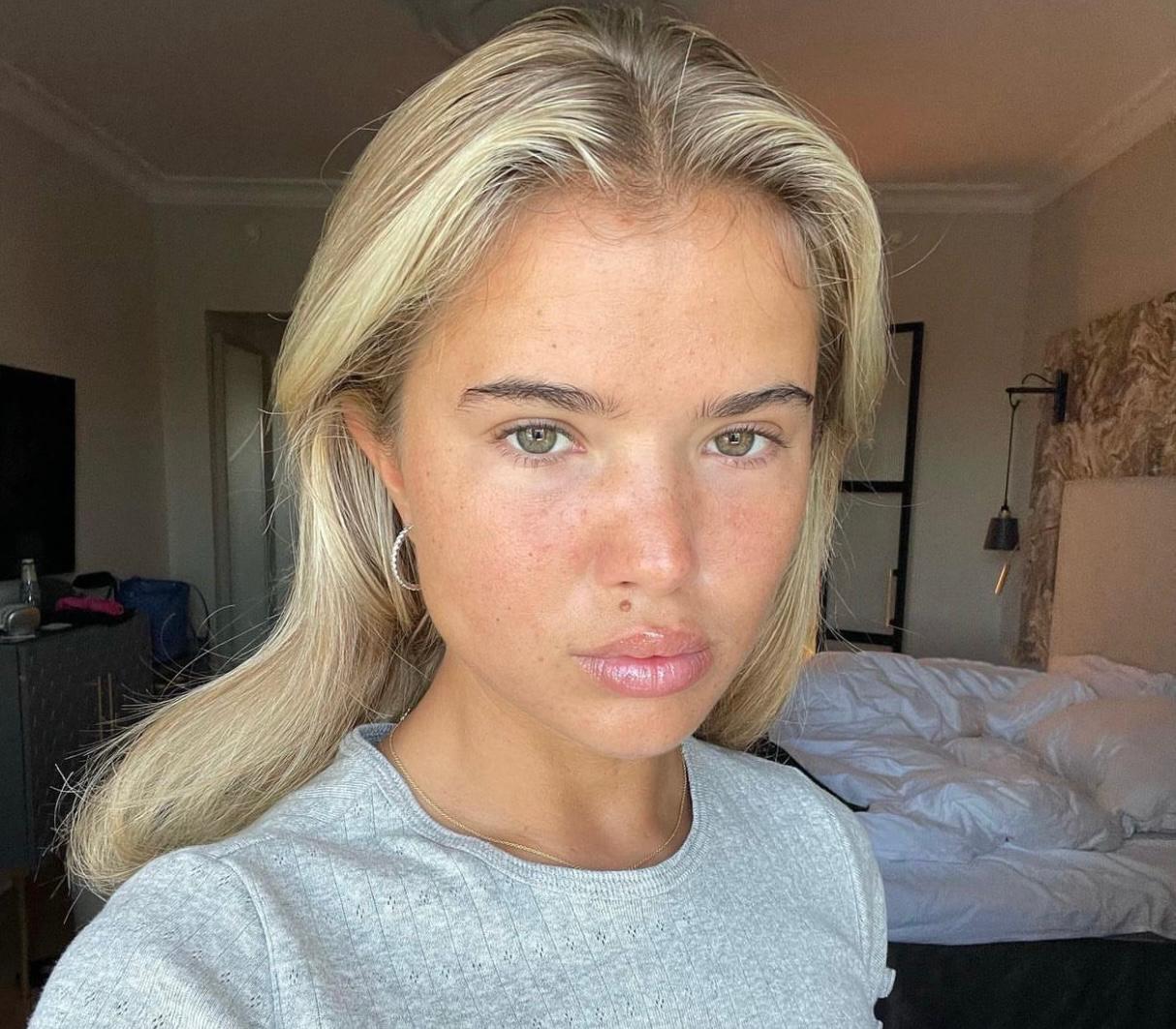 5 best cosmetic procedures for post-acne