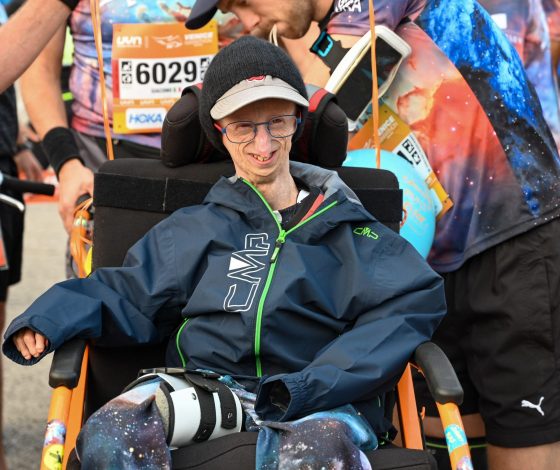 В 28 лет умер самый долгоживущий человек с синдромом быстрого старения