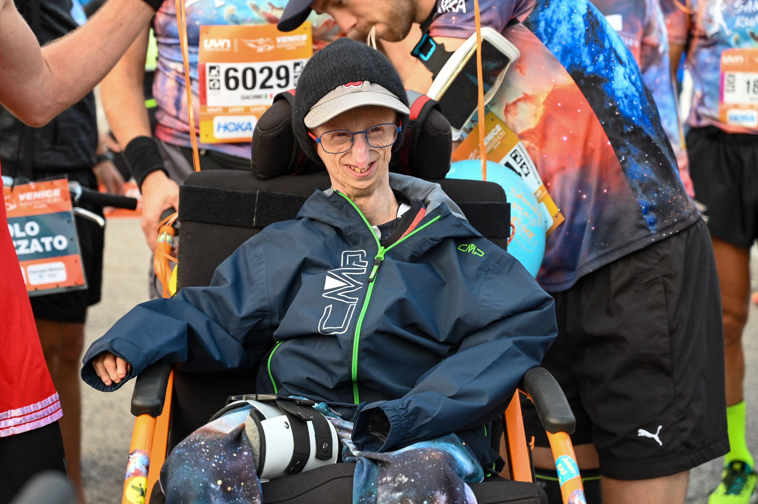 Longest living person with accelerated aging syndrome dies at 28